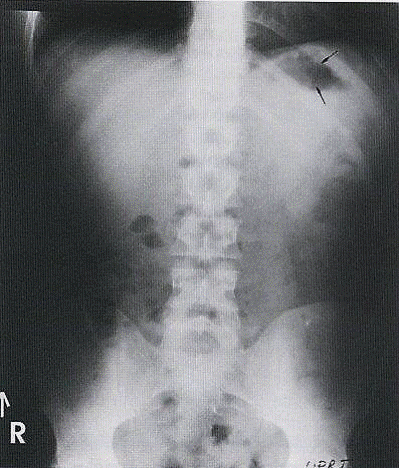 Radiografía Abdomen en Bipedestación